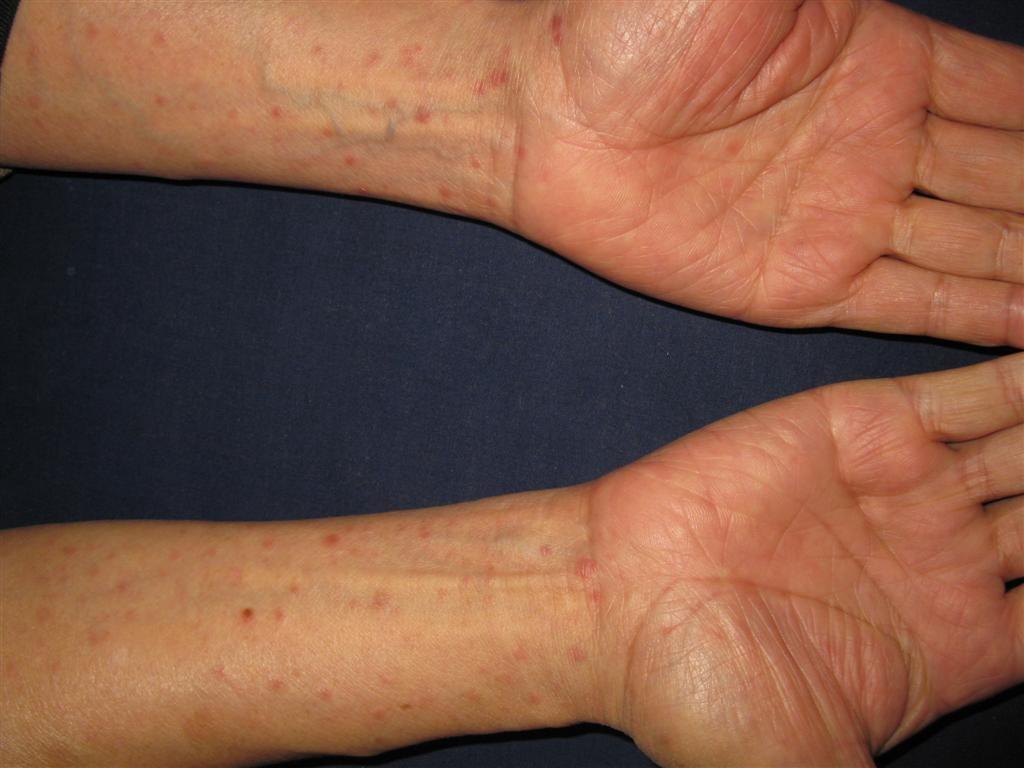 梅毒二期皮疹图初期图片