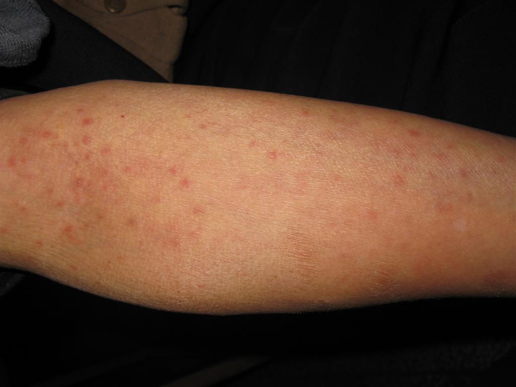 二期梅毒疹图片图片