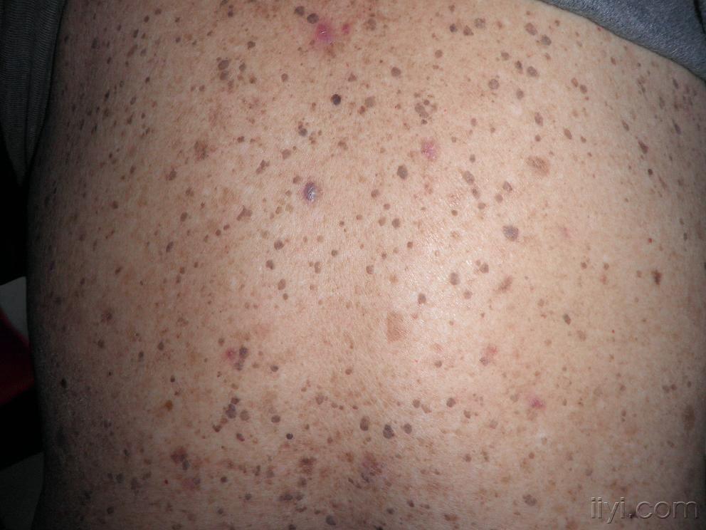 系列皮肤病——脂溢性角化