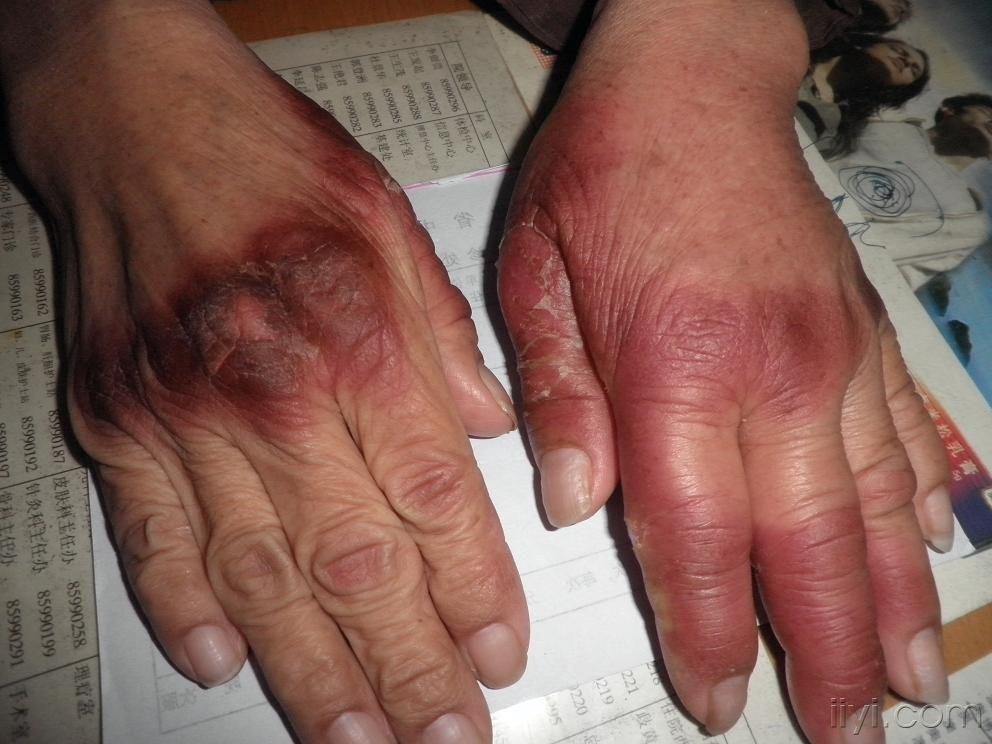 大家看看是啥病 - 皮肤及性传播疾病讨论版 - 爱爱医医学论坛 - 爱爱