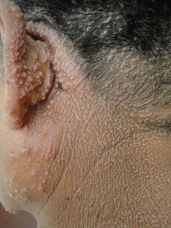 后在皮肤病医院做病理诊断为:黏液水肿性苔藓. 未正规治疗.