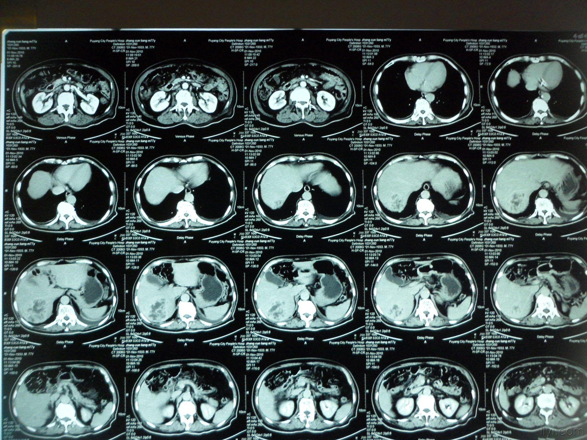 楼主hizhouyue2010-11-19 13:53:55   大家一起看看这个ct片子,说说你