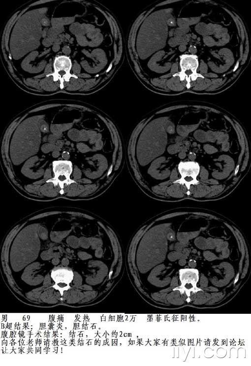 【共享】一例腹腔镜证实的特殊类型胆囊结石,请大家指教(如有类似图片