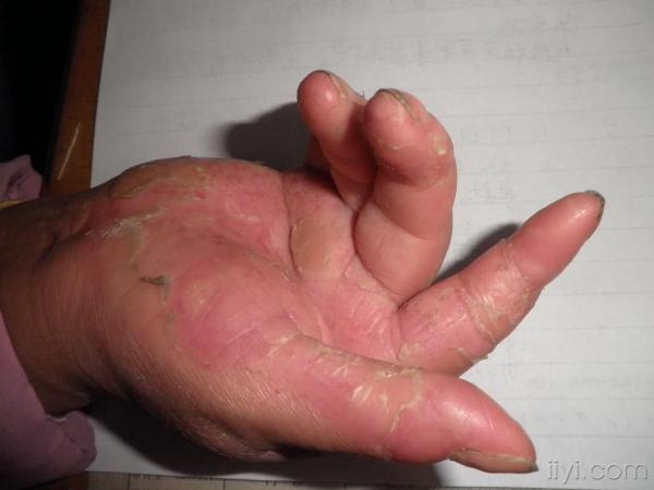 此照片是服用阿维a胶囊4个月后的皮疹情况,原来掌跖部位角化明显,服药