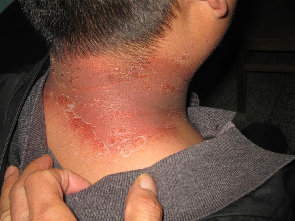 看图识病--------药疹