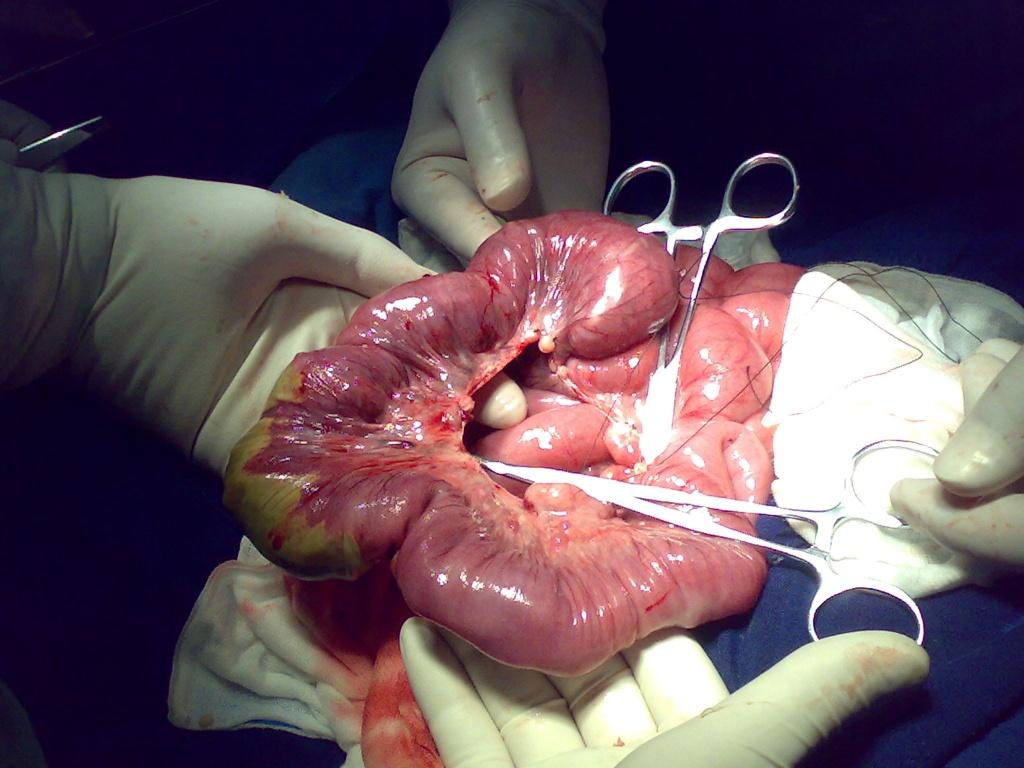 蛔虫导致肠梗阻和肠坏死