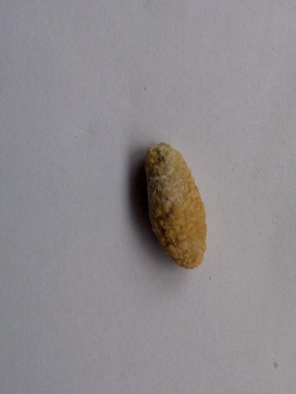 少见的涎石病反复感染当涎腺炎治疗一例!