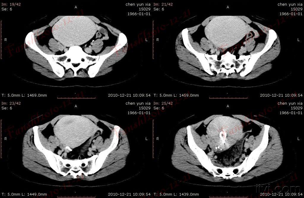 女性,44岁.偶然发现盆腔内肿物一个月余