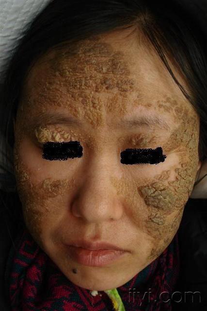 少见皮肤病----皮肤垢着病