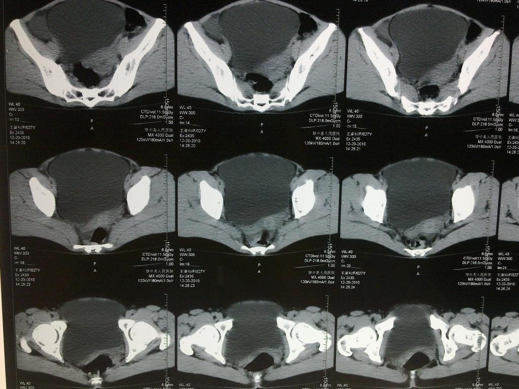 下腹盆腔内巨大包块.