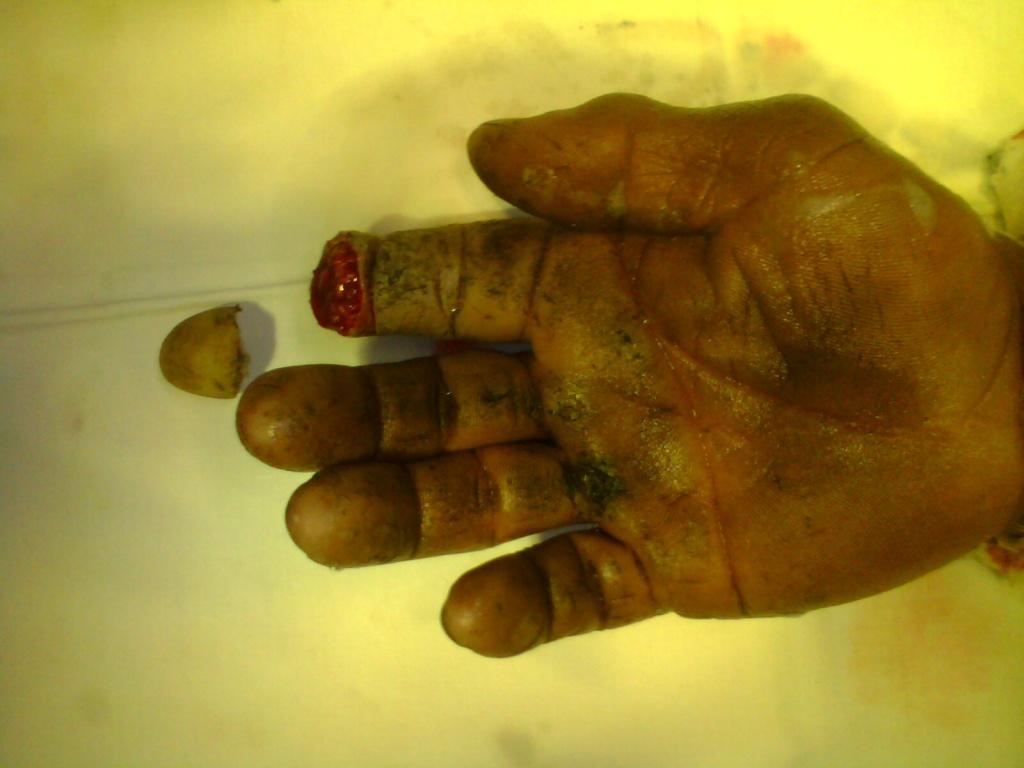 左食指末节完全离断