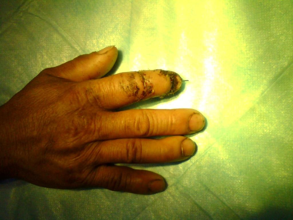 左食指末节完全离断