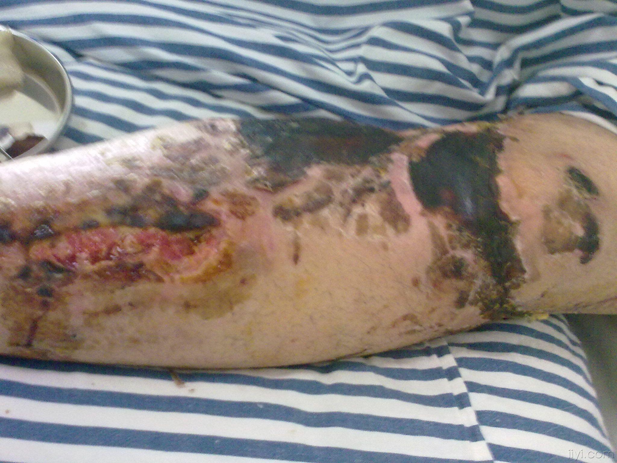 膝关节前侧皮肤坏死如何处理?