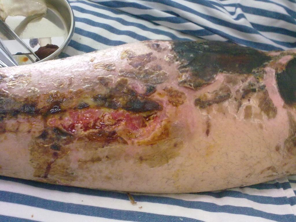 膝关节前侧皮肤坏死如何处理?