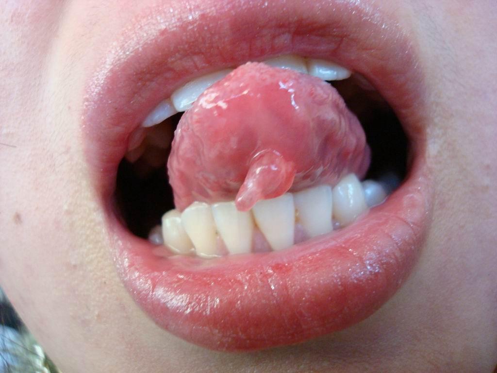 口腔粘膜粘液囊肿图片图片