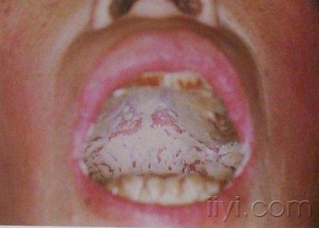 艾滋病口腔白色念珠菌图片