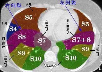 肺段划分ct图片