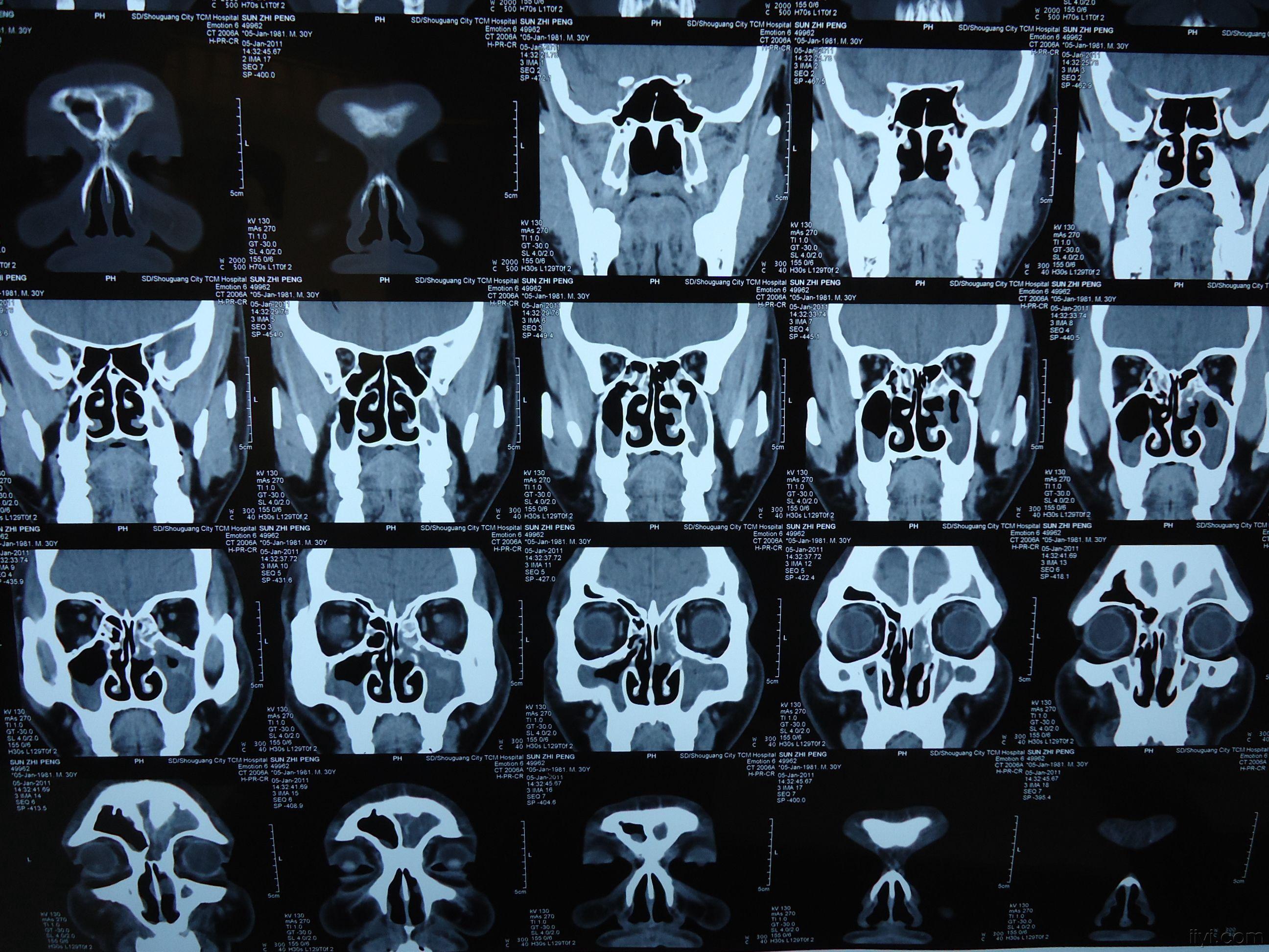 正常人鼻骨ct图图片