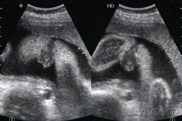 胎儿生殖系统超声图片图片