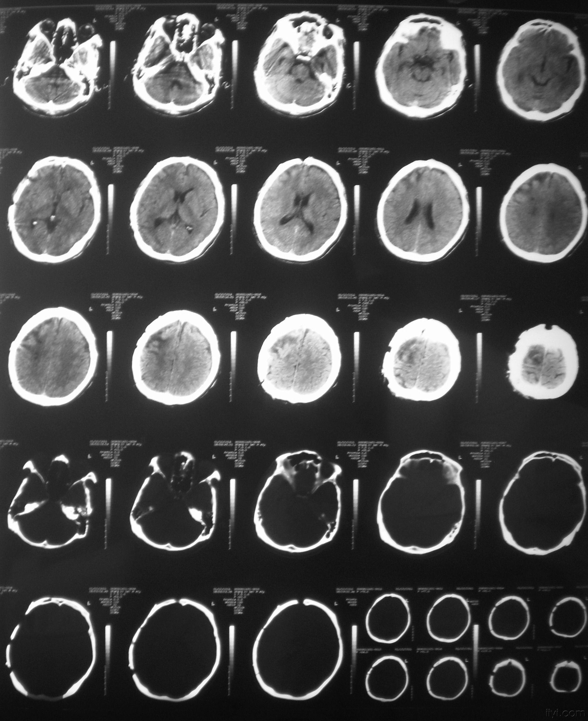 一例重度颅脑损伤患者的坎坷救治历程,欢迎大家来找茬!
