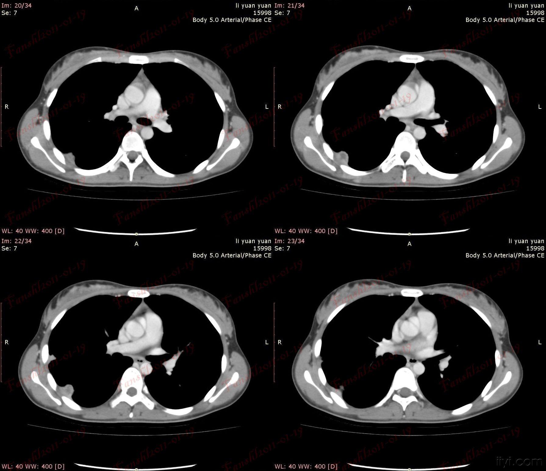 女性,22岁.右侧胸部多发丘状结节