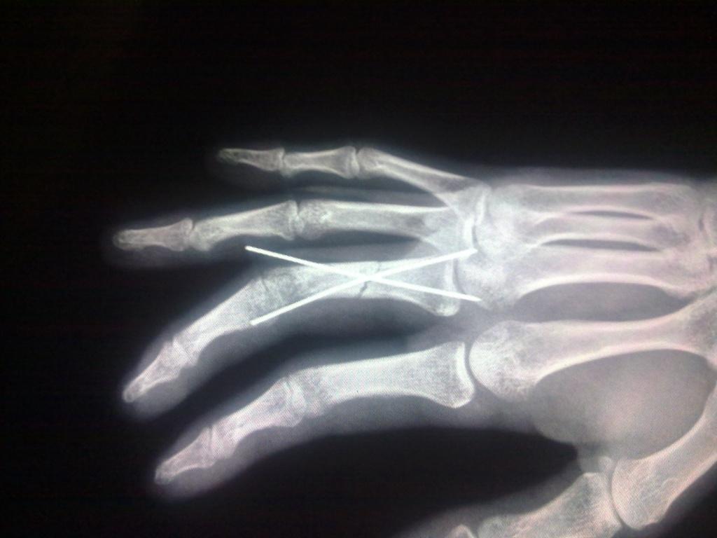 手指拇指籽骨x光片图图片