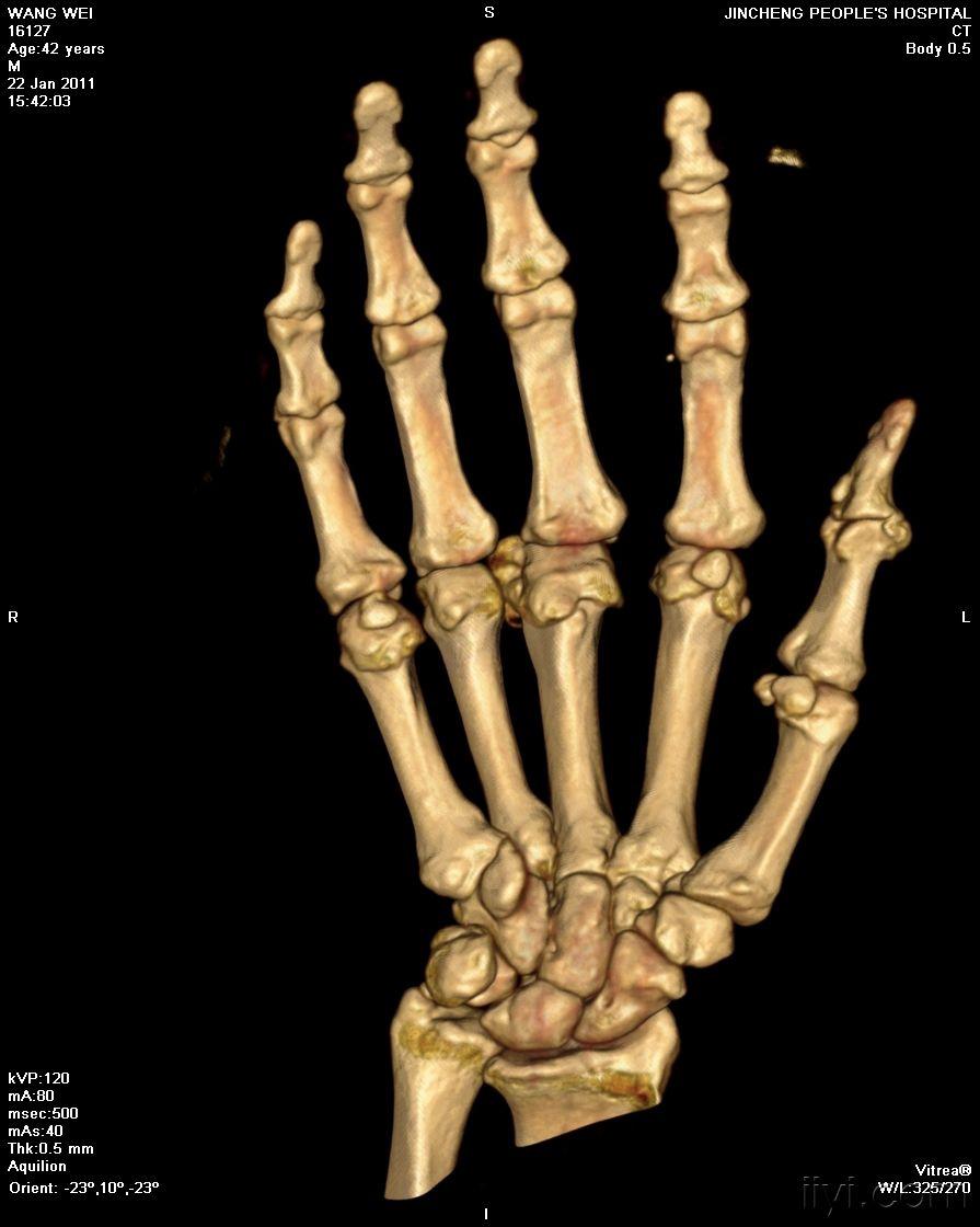 女性,72岁,发现右手掌指间小关节肿胀五年.