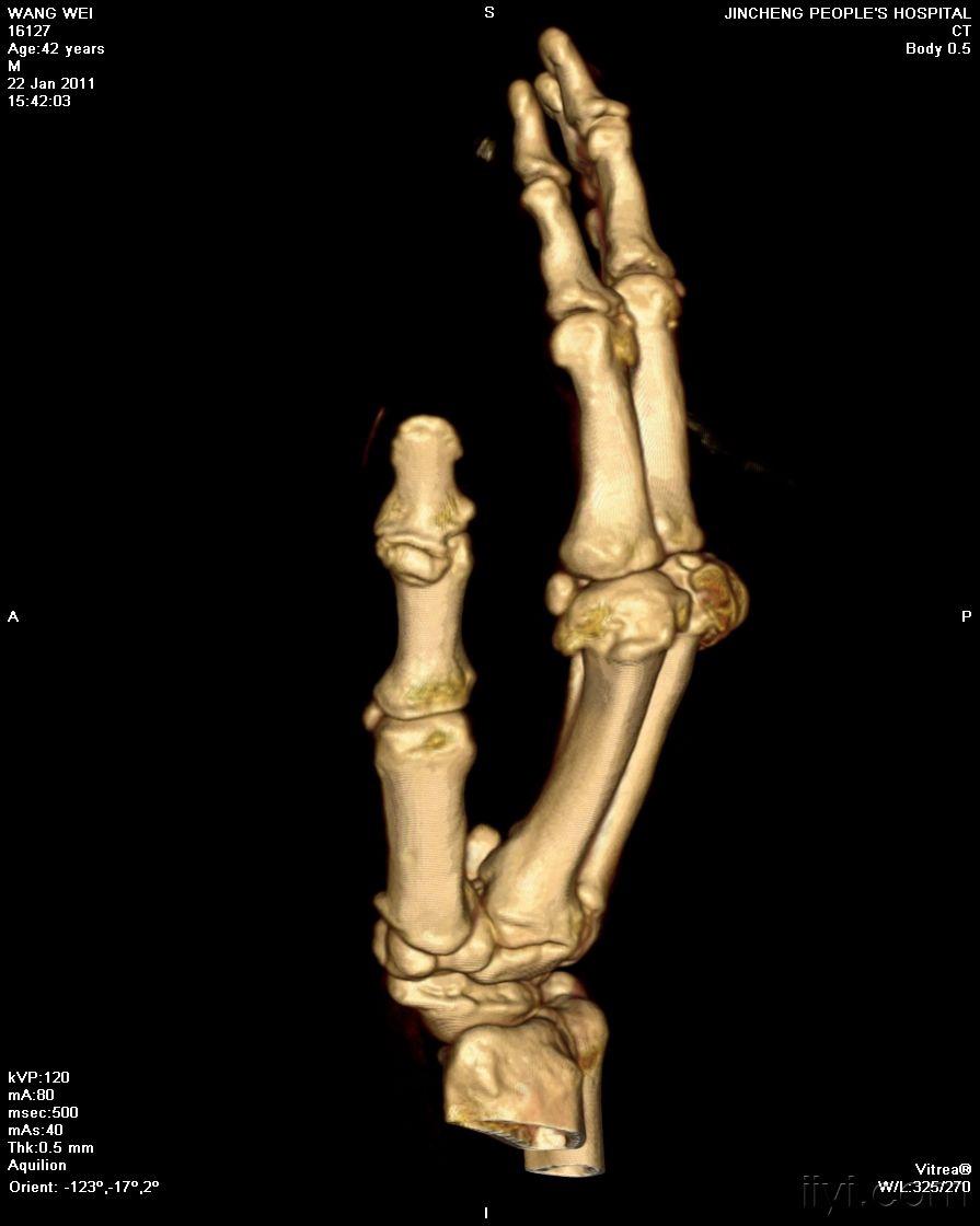 女性,72岁,发现右手掌指间小关节肿胀五年.