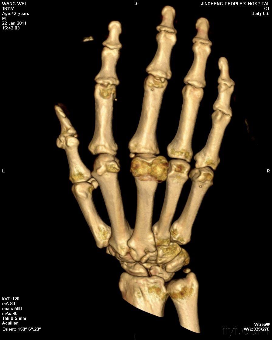 女性,72岁,发现右手掌指间小关节肿胀五年 