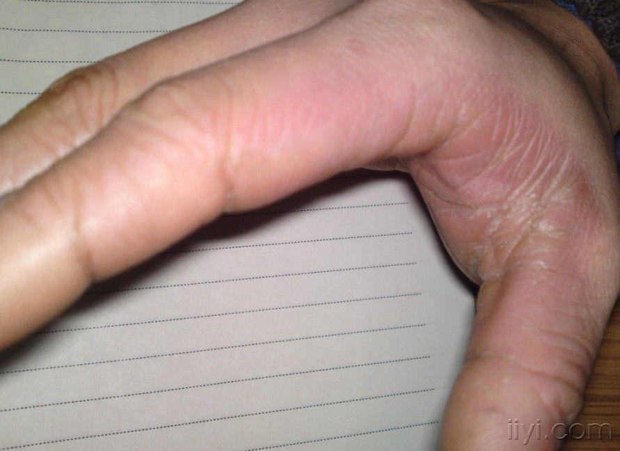 鱼肝油软膏鸡皮肤(鱼肝油软膏可以治疗鸡皮肤吗)