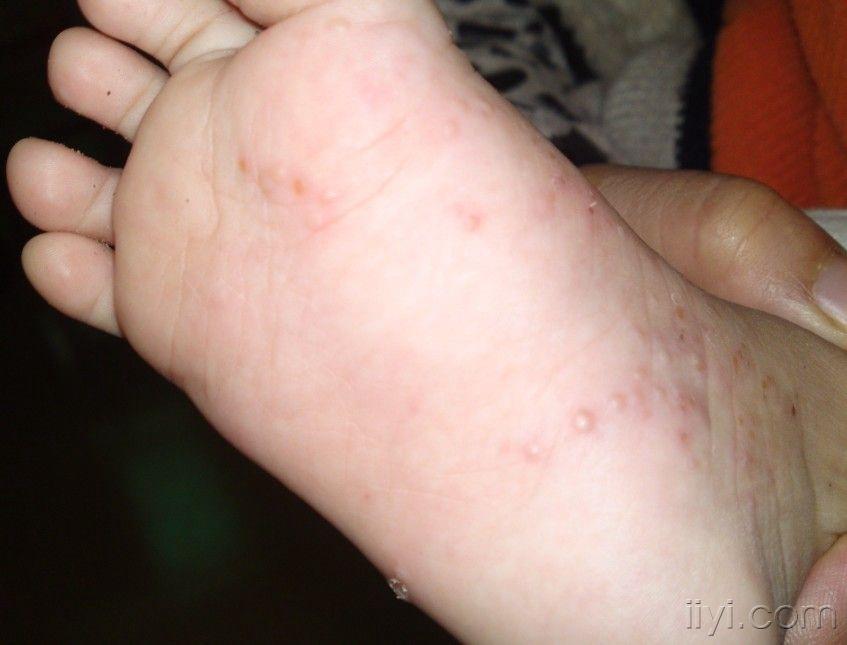 水泡型湿疹的症状图片图片