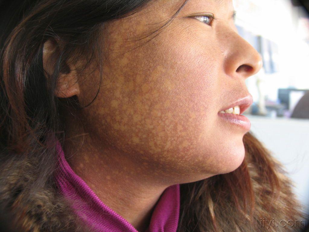 20:45:56黑变病 板凳回复lj83862862011-02-09 09:13:17西瓦特皮肤