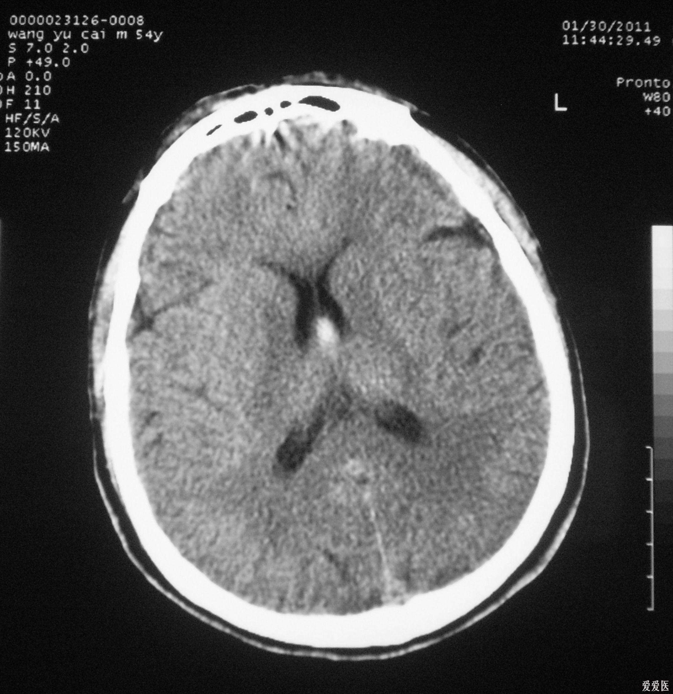 头部外伤史,透明隔高密度,大家看看是不是血肿