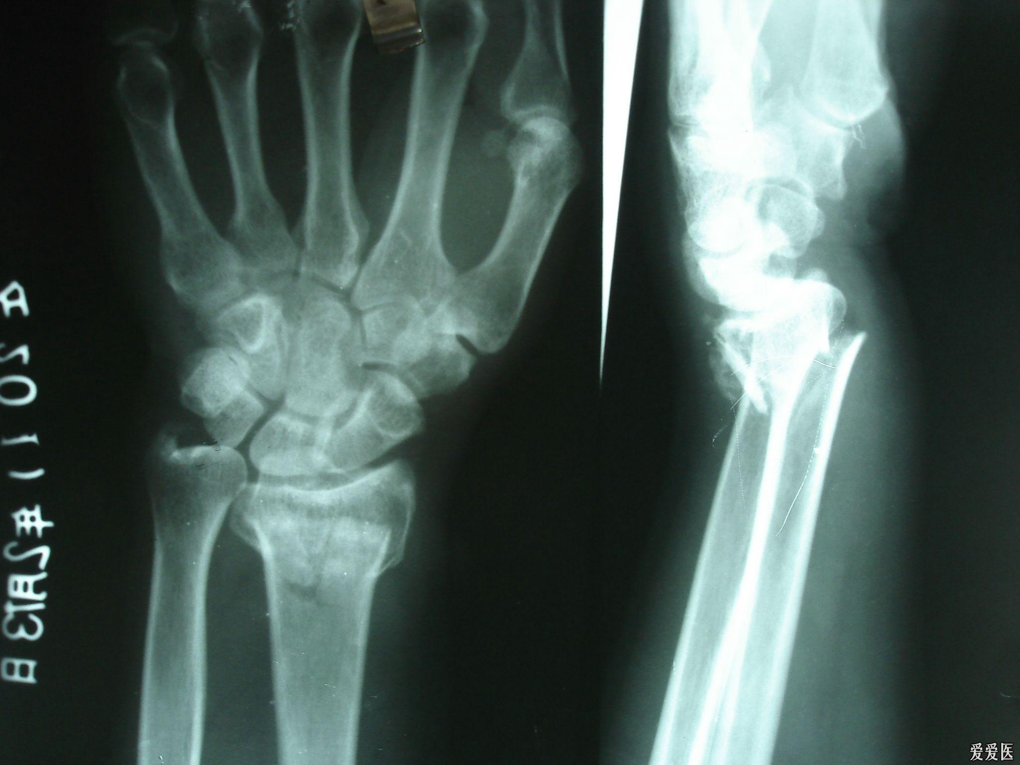 左侧桡骨远端骨折手法复位一例