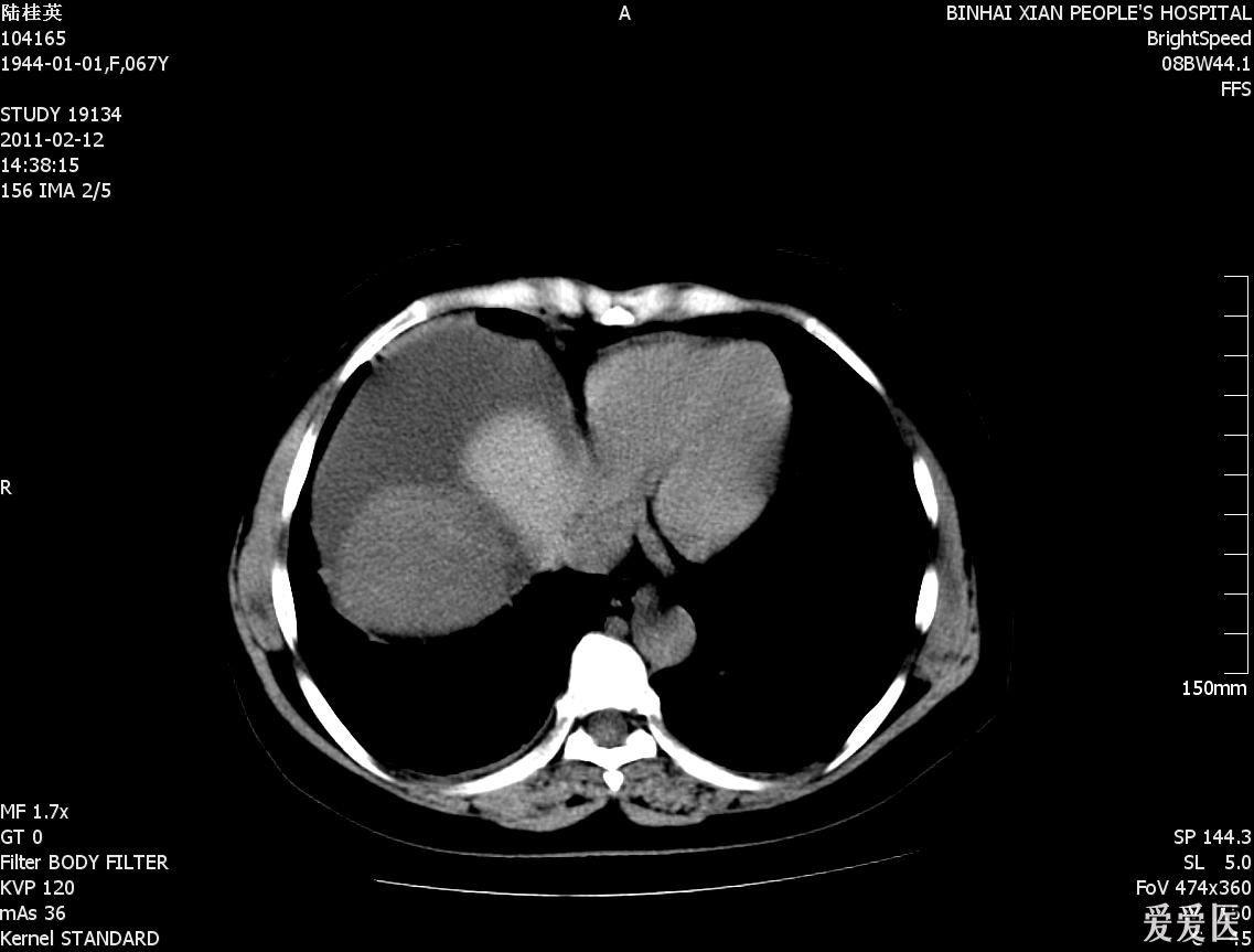 请大家看看哦 膈肌肿瘤?