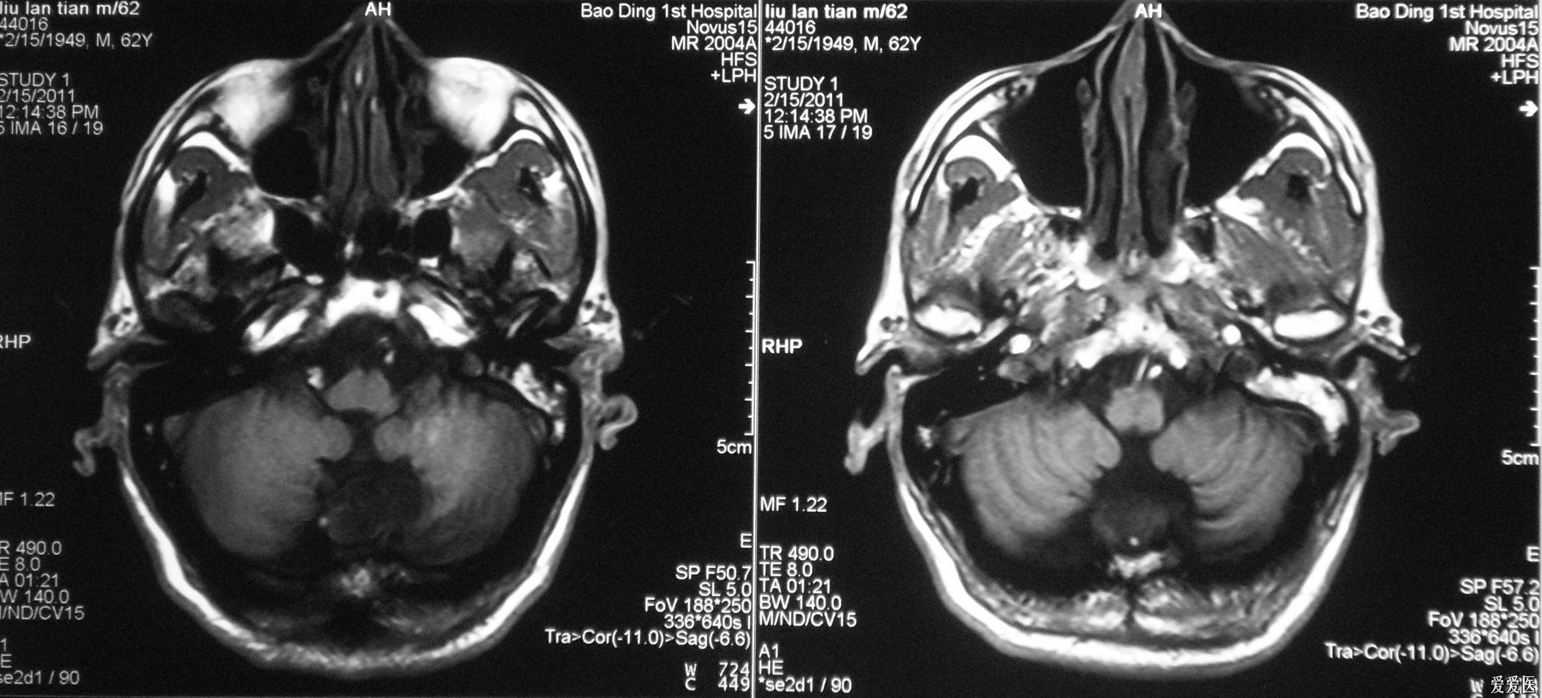 小脑蚓部CT图片