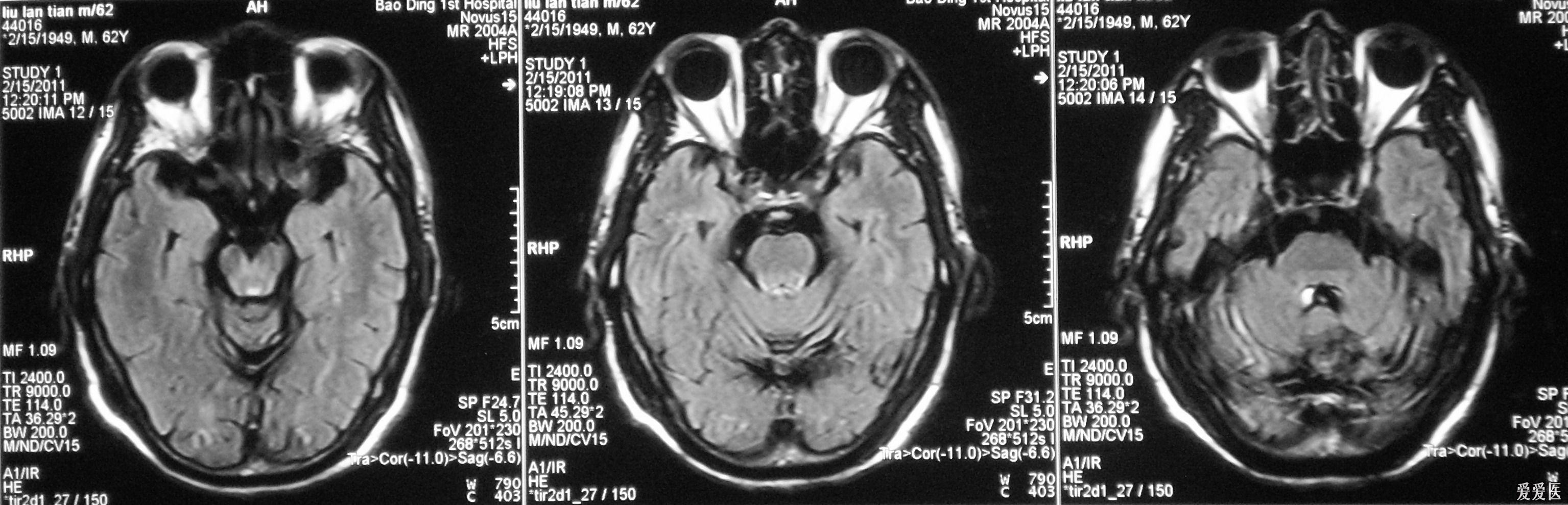 小脑蚓部CT图片