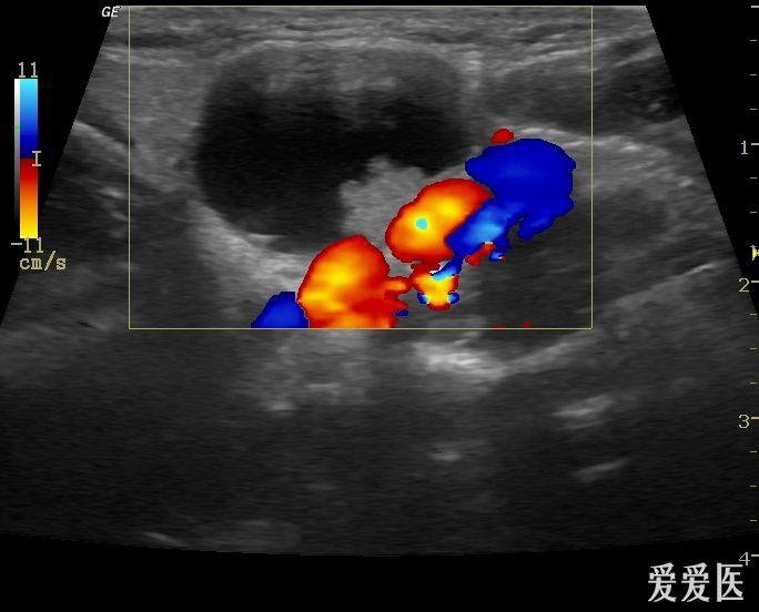 甲状腺乳头状癌并颈部淋巴结转移