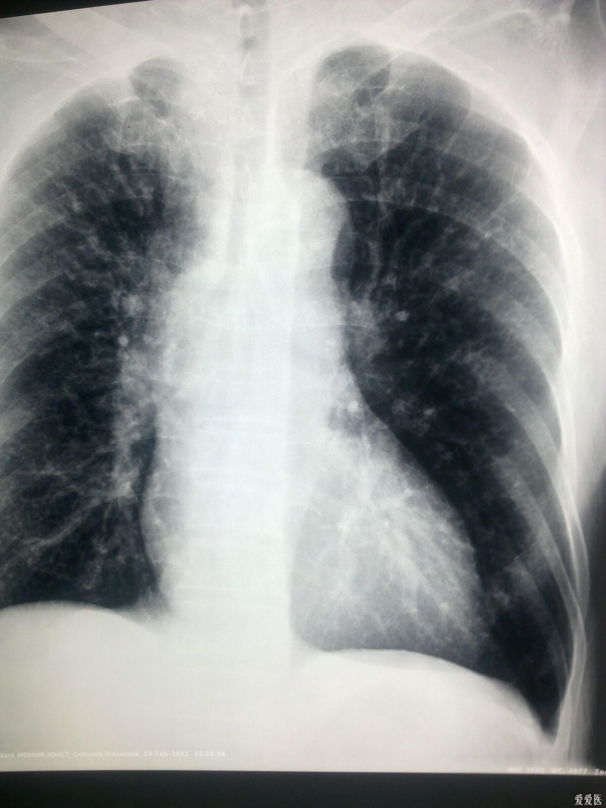 肺部感染的胸片图图片