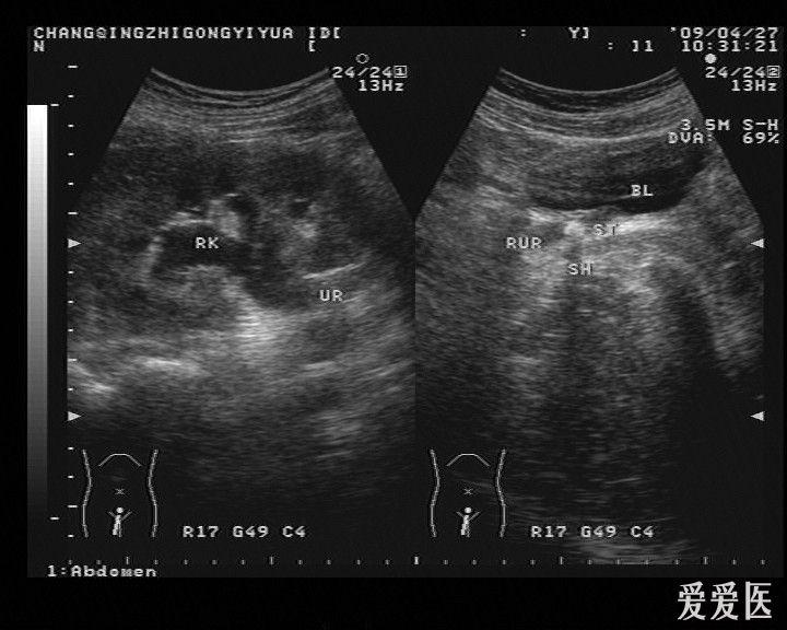 输尿管结石致右肾积水