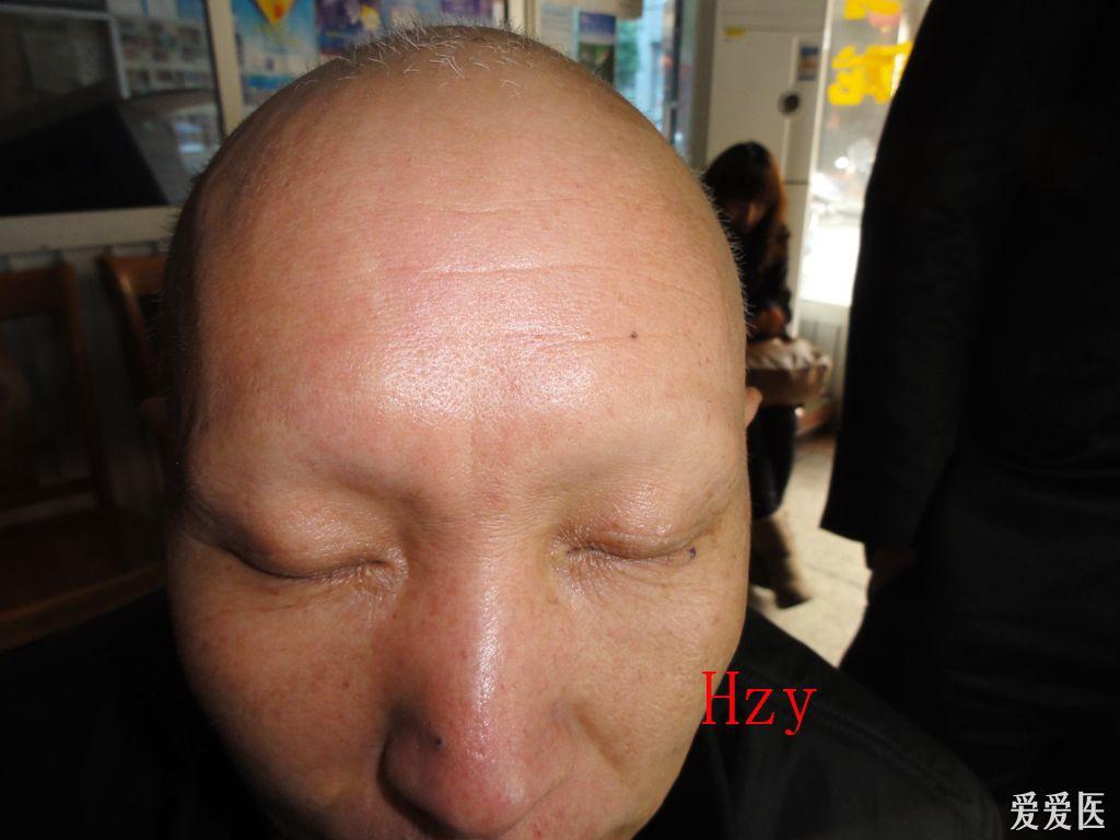 看图识病------普秃