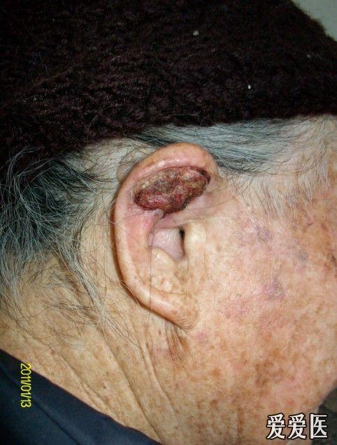 看看图片 已病例确诊 ----鳞状细胞癌 - 皮肤及性传播疾病讨论版