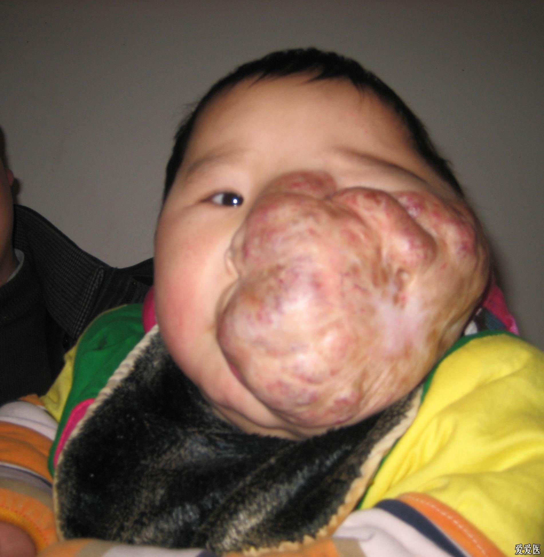 孩子脸上血管瘤图片图片