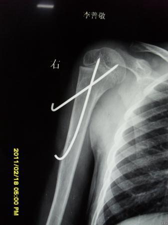 肱骨解剖颈骨折图片