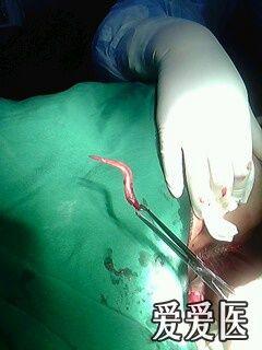 鱼刺导致的肛周脓肿