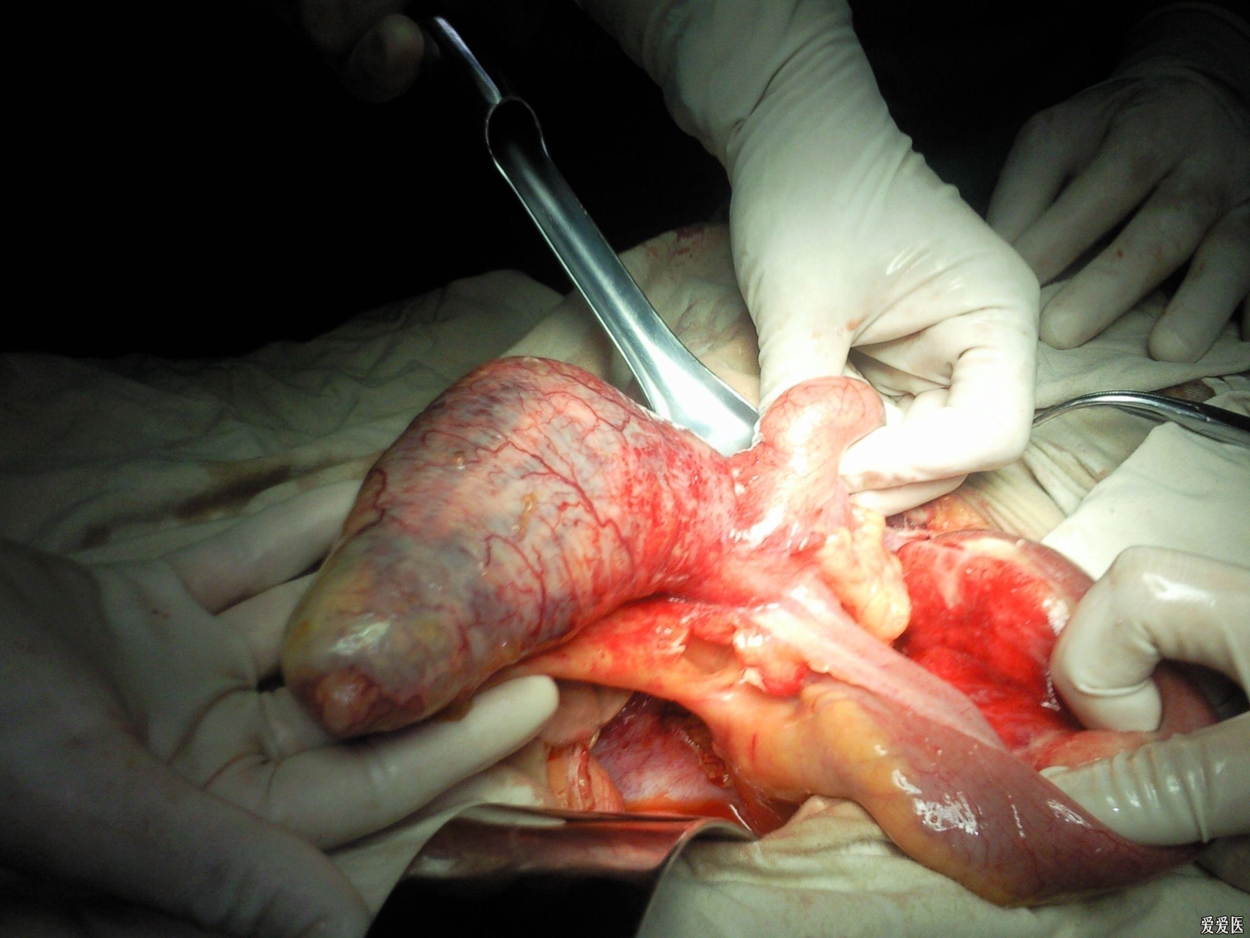 巨无霸大阑尾,(申请加分)