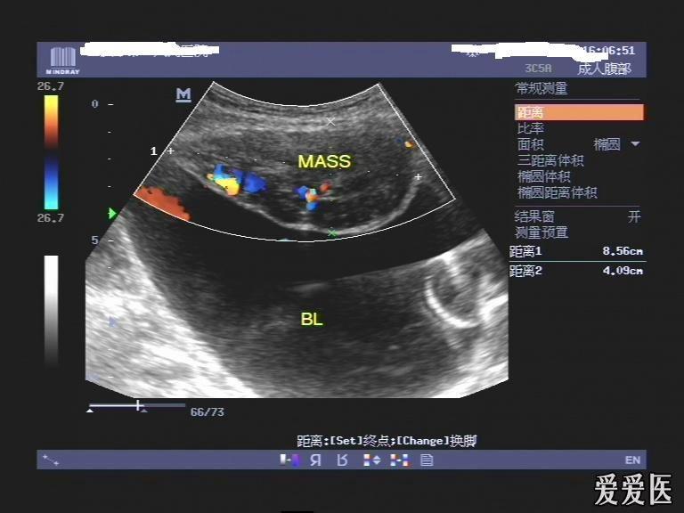 膀胱肿瘤超声图片