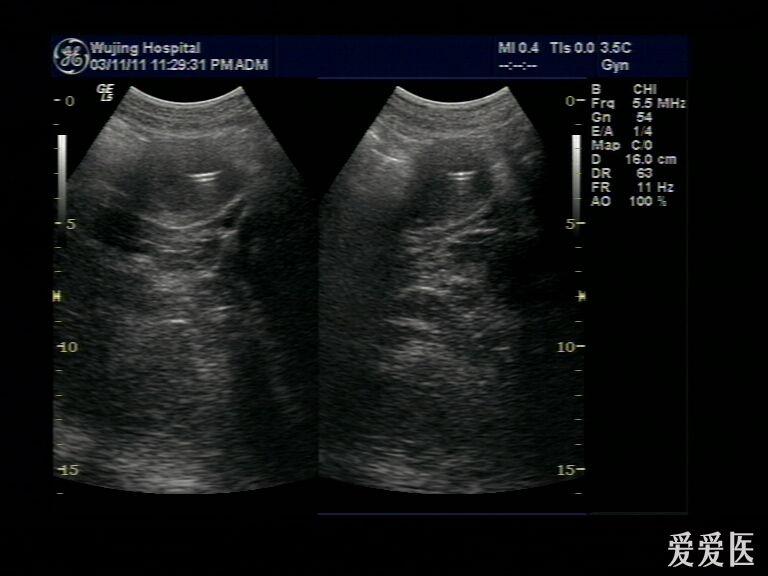 取环后宫腔内强回声 - 超声医学讨论版 - 爱爱医医学论坛 - 爱爱医
