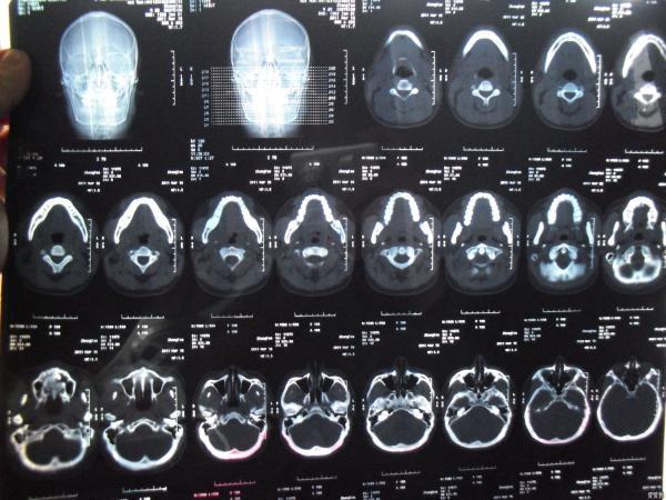 上颌含牙囊肿,跪求医生给意见或是病友探讨