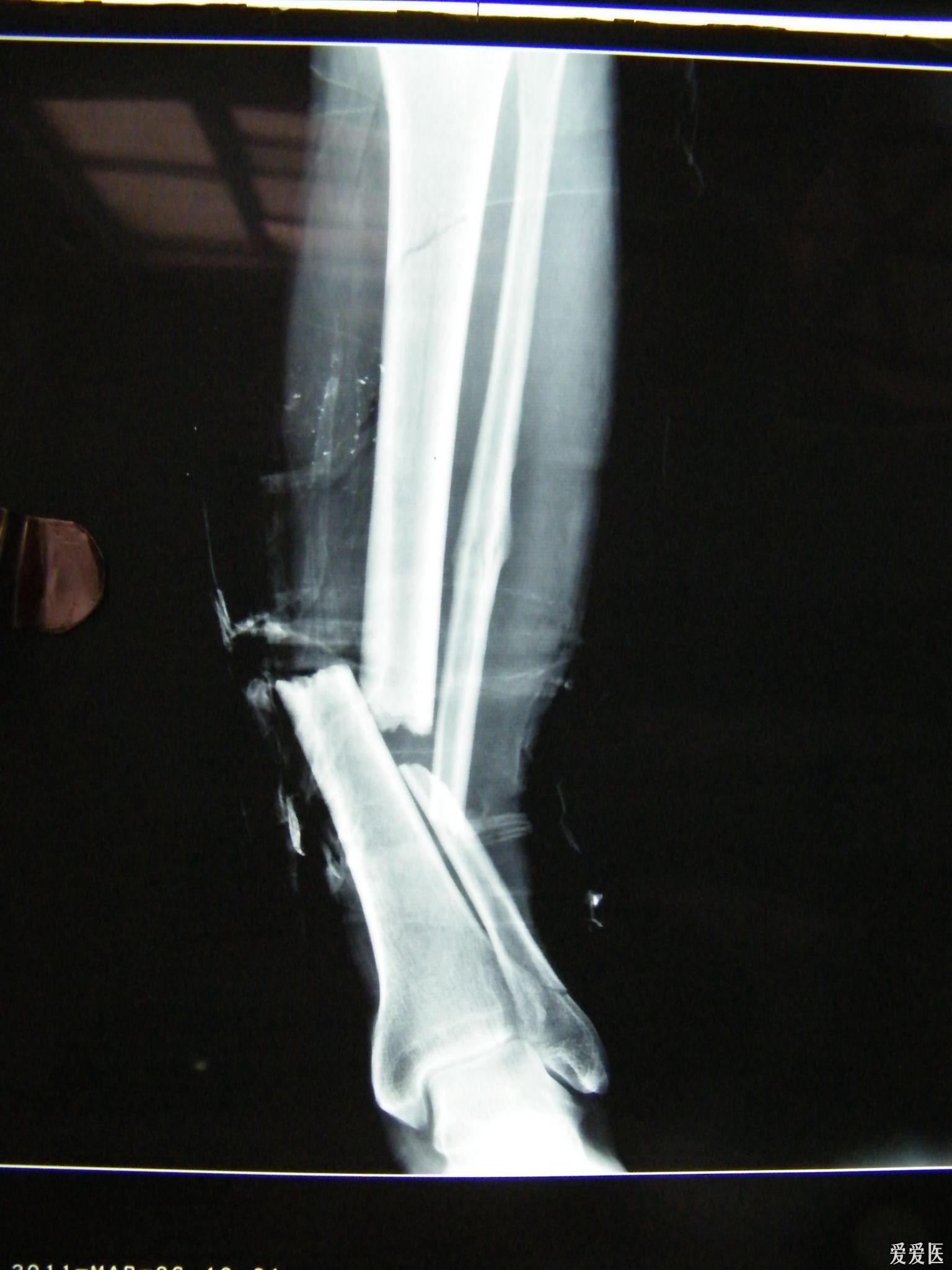 左胫腓骨开放性多段骨折
